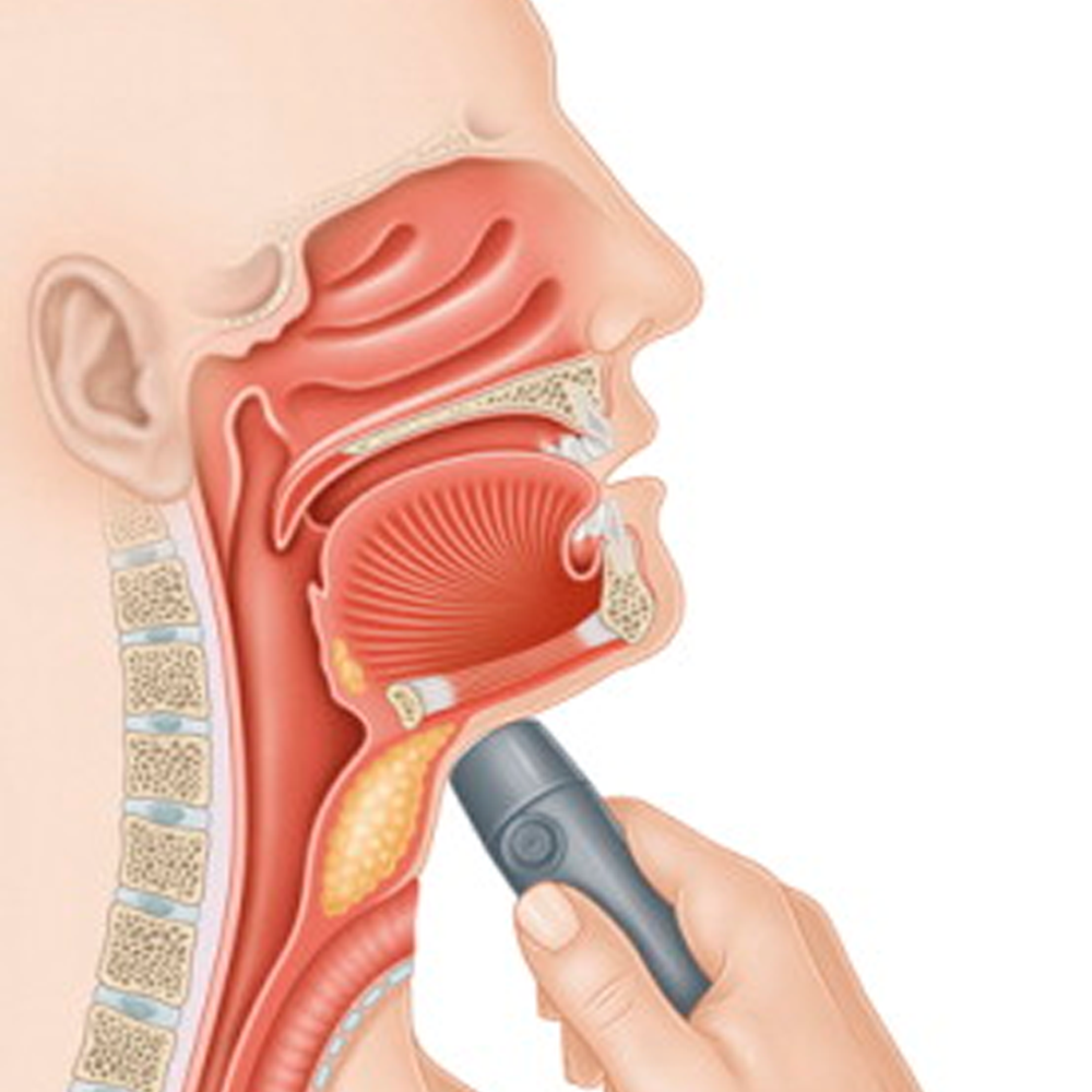 Laringe Digital NuVois III